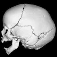 Краниосиностозы и черепно-лицевые (кранио-фациальные) дизостозы любой сложности