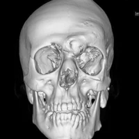 Опухоли черепа