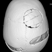 Дефекты и деформации черепа любой сложности и локализации