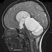 Опухоли головного и спинного мозга