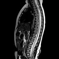 Аномалия Арнольда-Киари, сирингомиелия