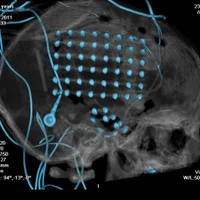 Фармакорезистентная эпилепсия