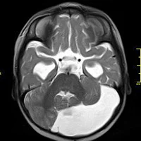 Пороки развития головного мозга