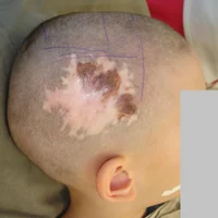 Рубцовые деформации и дефекты кожи волосистой части головы