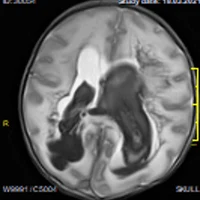 Внутрижелудочковые кровоизлияния
