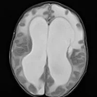 Гидроцефалия