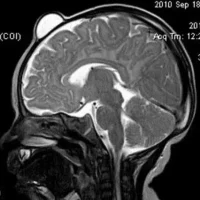 Дермальные синусы, дермоидные кисты и перикраниальные синусы
