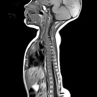 Пороки развития позвоночника и спинного мозга